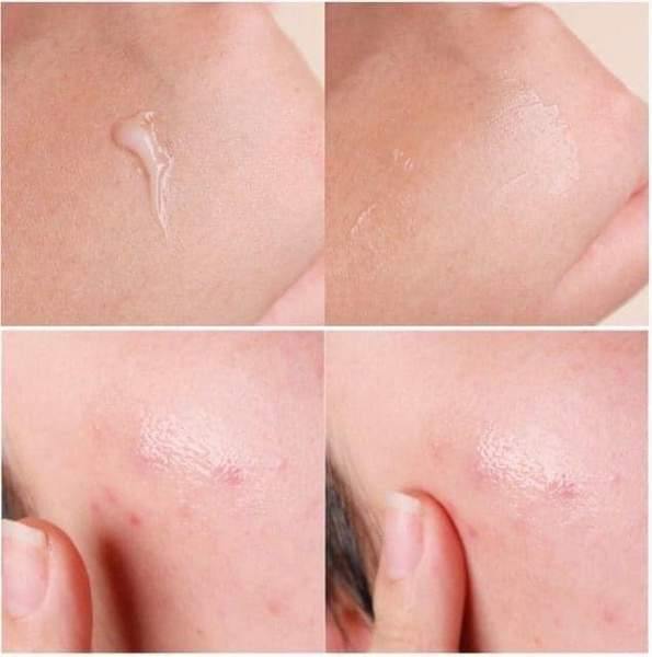 Dong-A Pharm Noscarna Acne Scars Removal Gels Face Facial Creams Large Size 20g Best help for getting rid of pimples Decent spot