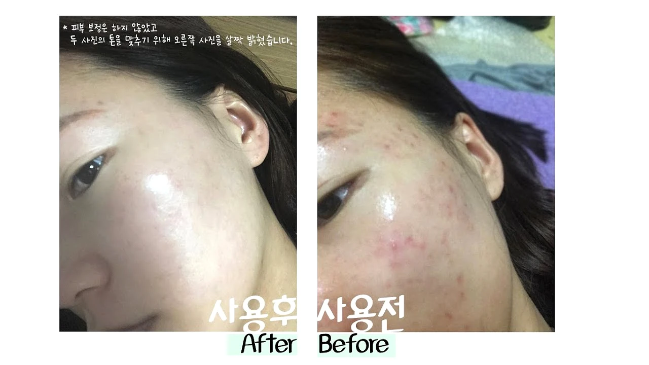 Dong-A Pharm Noscarna Acne Scars Removal Gels Face Facial Creams Large Size 20g Best help for getting rid of pimples Decent spot